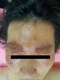 アトピー性皮膚炎　顔　40代　女性